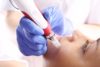 Dermapen