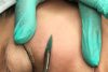 Dermaplaning